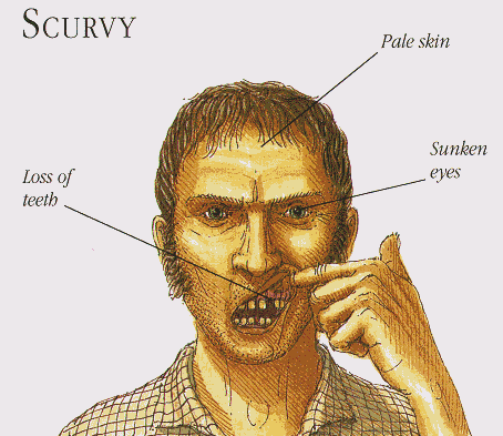 scurvy.gif
